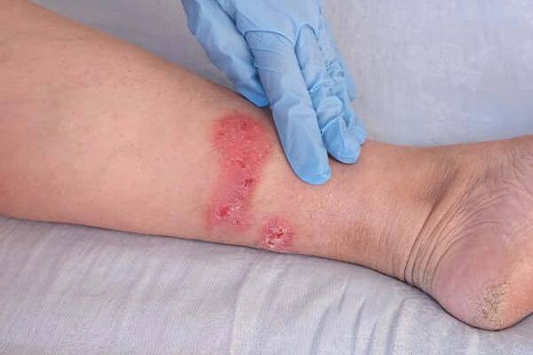 Skin & Soft tissue Infection Treatment- Dr. A. Murali